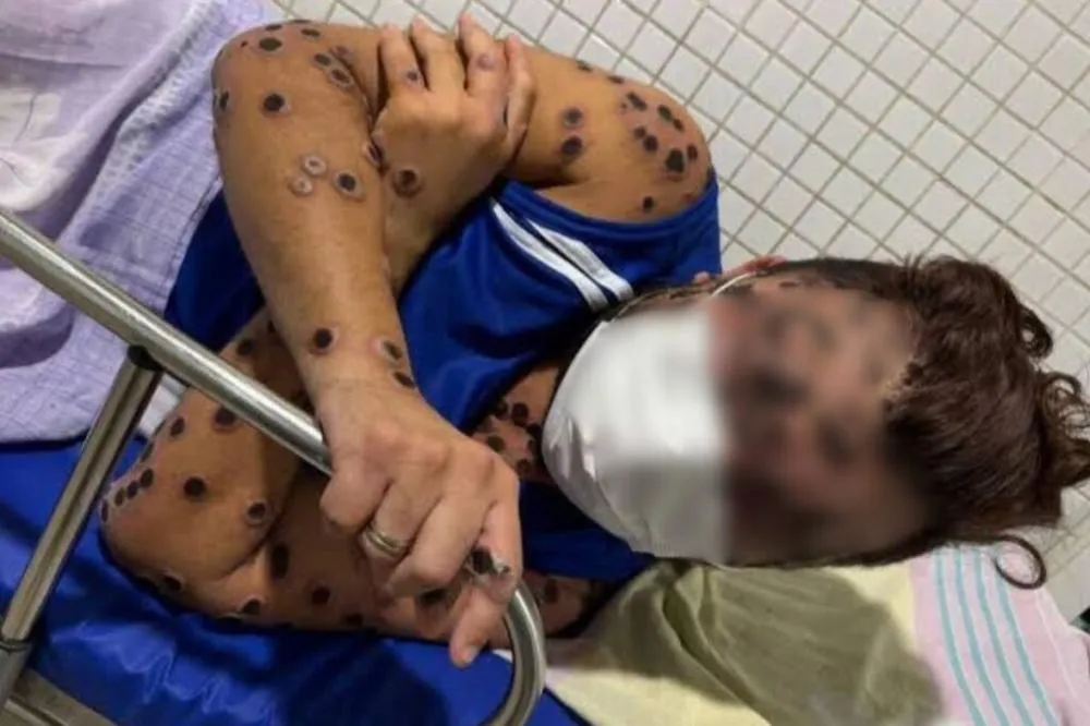O Ceará confirmou o terceiro caso de Mpox em 2026